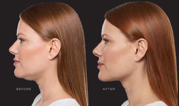 Kybella Macon GA