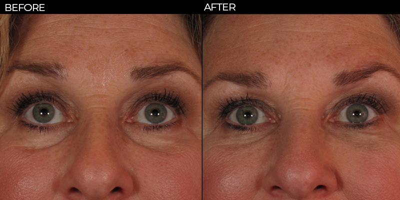 Under Eye Bags Treatments, Eye Rejuvenation Macon & Madison, GA